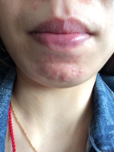 下巴一直这样长痘,白色的脓头,本人经期正常,去看过皮肤科,是说痤疮