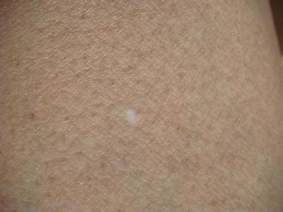 白色糠疹治疗,白色糠疹症状,白色糠疹检查与预防_百姓健康网