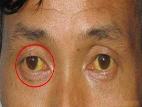 巩膜发黄是临床诊治肝脏病症的一个重要依据,比如我们常见的急性乙肝