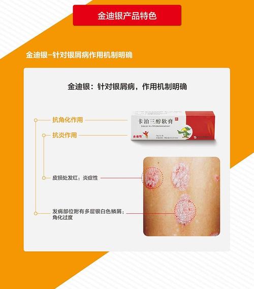 金迪银卡泊三醇软膏15g卡伯卡波三醇三淳外用卡泊三淳卡伯三淳卡泊三