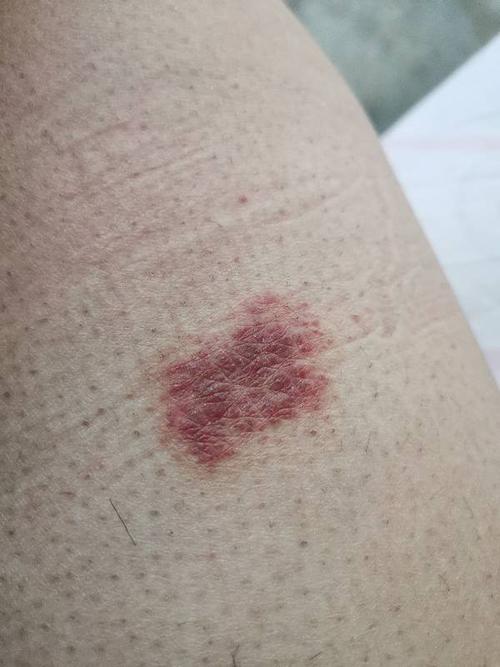 皮肤问题,请问下我这大腿上面有一片红斑是什么啊?