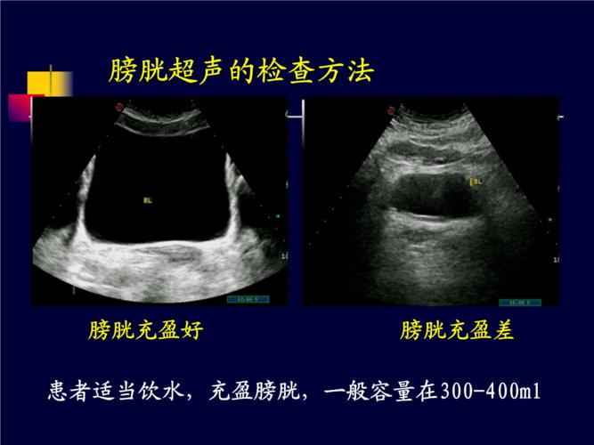 12章3膀胱超声.ppt 29页