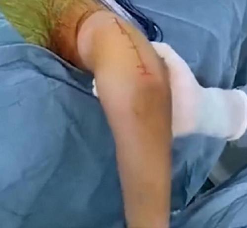女生团建掰手腕上臂当场被扭断