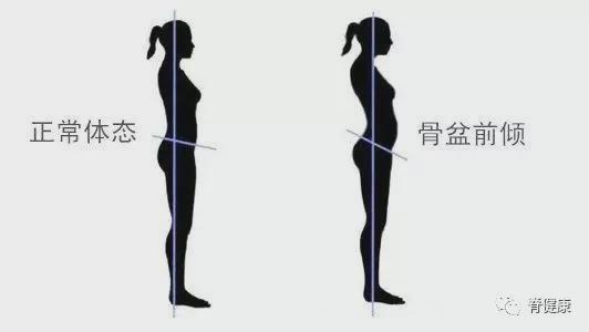 > 类似下面这样这种情况我们一般称为骨盆前倾但是肚子也不小啊臀确实
