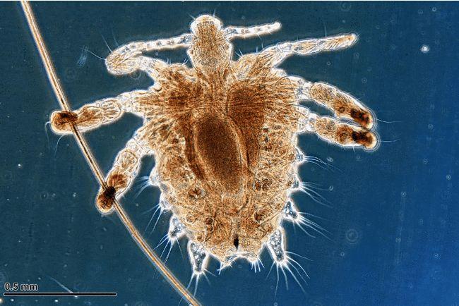 阴虱是一种可经性传播的寄生虫病,但不属于性病.