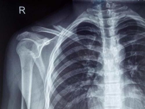 拯救美人骨——锁骨