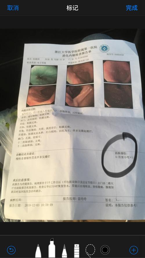 请问下我检查胃镜诊断结果慢性非萎缩性胃炎伴多发窦烂.