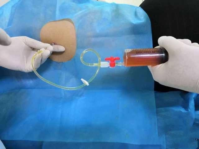 胸腔积液反反复复还抽不抽怎样才能有效治疗积液避免反复