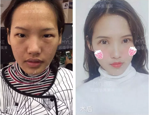 昆明肿眼泡可以做双眼皮手术矫正吗?