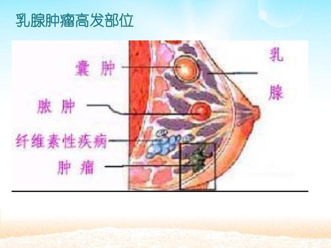 乳腺癌幻灯片