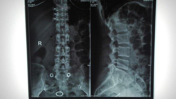 患者于一月余前搬东西时不慎腰部受伤,造成腰部持续性腰痛,伴随左臀部