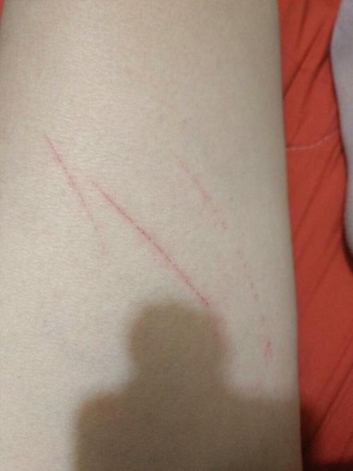 为什么会突然出现这些伤痕,腹部也有.