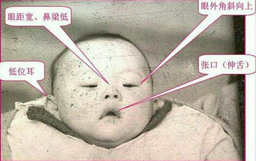 你知道什么是"唐氏儿"吗?