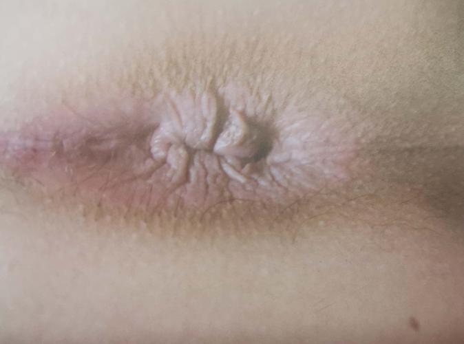 肛周湿疹症状_病因_治疗方法_鉴别_专家咨询|丁香医生