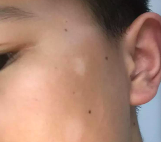 孩子脸上出现白斑就一定是白癜风吗这样的白斑不可怕
