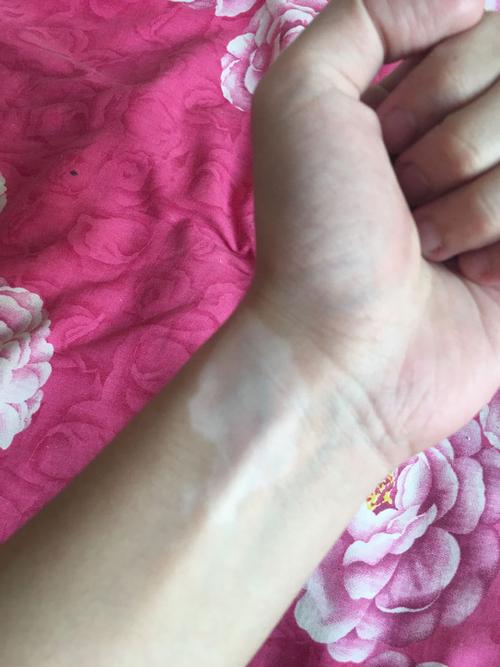 手臂突然出现白色色块,是白癜风吗?
