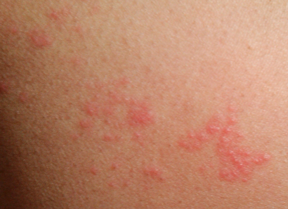 孩子皮肤过敏如何是好 为什么会出现皮肤过敏的情况