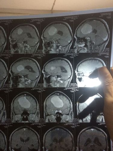 脑膜瘤,哪位神医能给我们斟酌一下这是良性