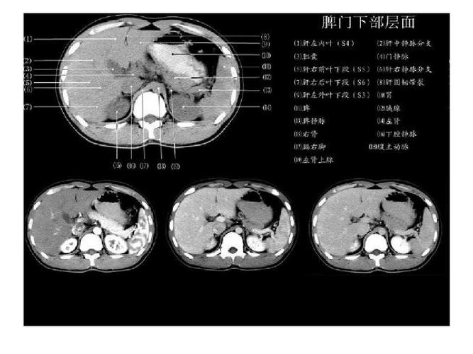正常肝脏ct解剖ppt