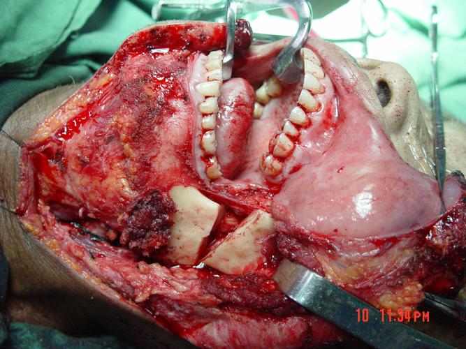 鼻咽癌放疗后复发,大出血以及张口受限并非不能治疗!