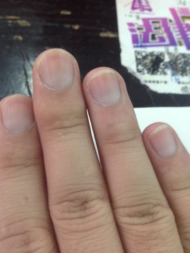现在其他手指出现了这种情况,但是颜色很浅大拇指月牙白外围也出现这