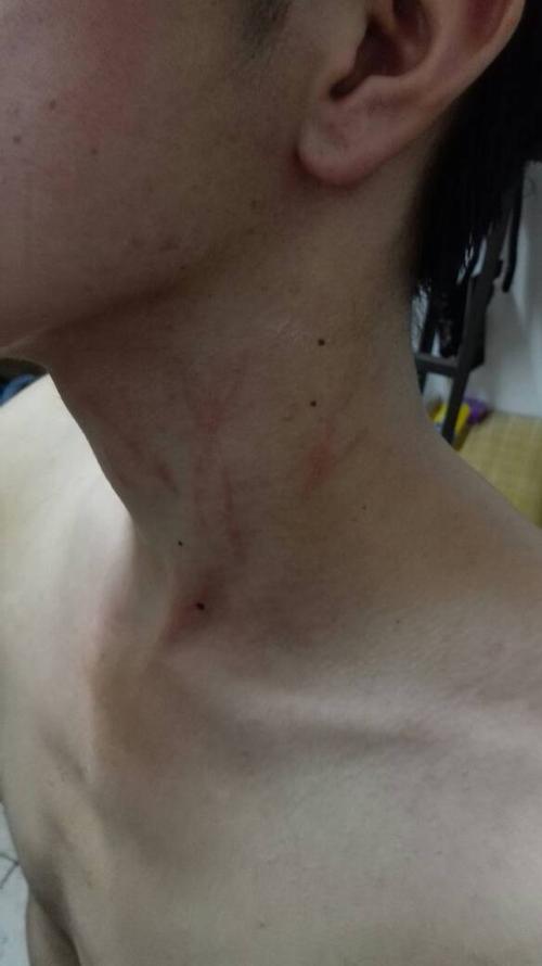 最近几天脖子上出现红色的像是被划伤的痕迹.摸上去还有一点点痛感.