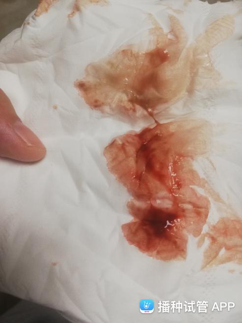 [试管婴儿]第32天,做b超宫腔积液,吃着