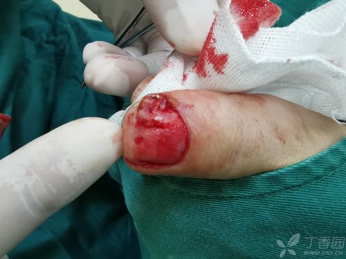 门诊随以左侧拇趾嵌甲 甲沟炎嘱患者于日间手术室行左侧拇趾拔甲术