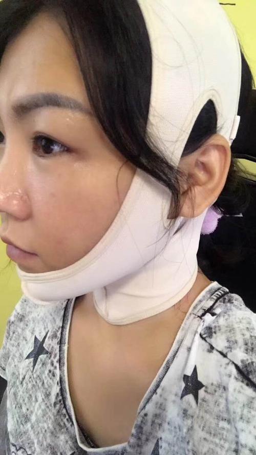 相关知识分享: 线雕后一定要带绷带吗…… 全脸线雕是要戴绷带的,因