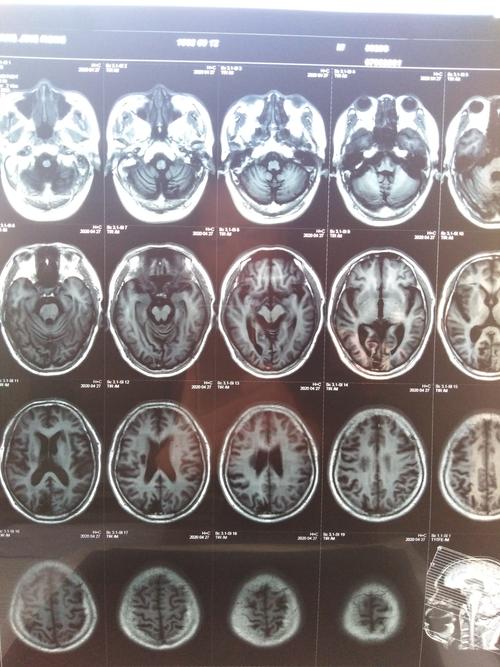 脑部核磁共振片显示,血管无斑块.