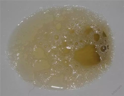 又如何辨别糖尿病的并发症呢? 糖尿病者,身体有四种表现,警惕并发