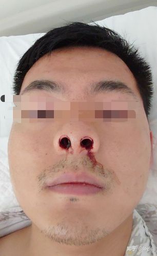 我的鼻中隔偏曲手术治疗经历