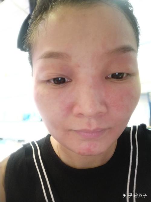 记录我和激素依赖性皮炎斗争的过程