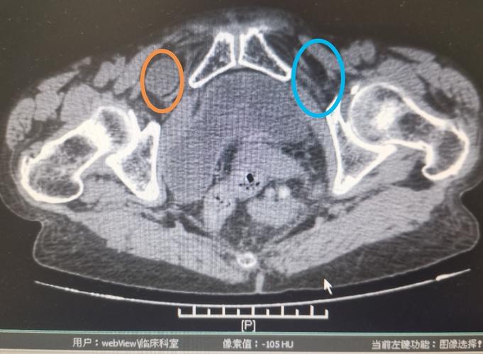 闭孔疝相关科普_腹外疝 - 好大夫在线