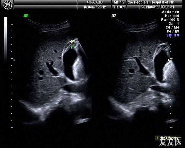 胆囊腺肌症可能,请指教