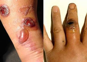 皮肤炭疽传染病 了解临床表现及时控制