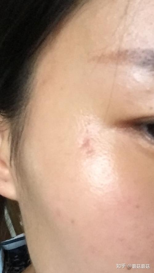 皮脂腺囊肿长在脸上了,医生说只能手术?