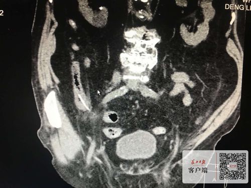 腹痛被当做阑尾炎治疗,3厘米鱼刺扎进肠子两个月,八旬