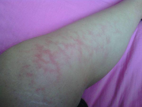 刚刚烤火烤出了红斑,怎么办.我的腿tt