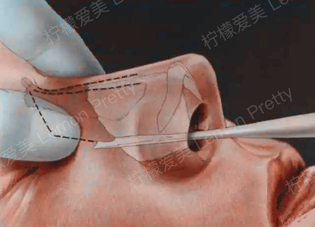 鼻骨内推会让鼻子变高吗?