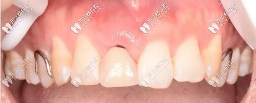 门牙外伤,瑞士iti钛亲水4.1*10mmbl即刻种植牙修复案例超全解析