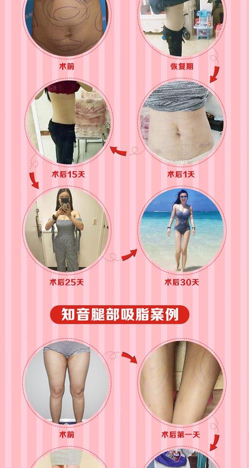 腰腹吸脂 3年质保 院长/主任医师操刀 随做随走 即刻显瘦