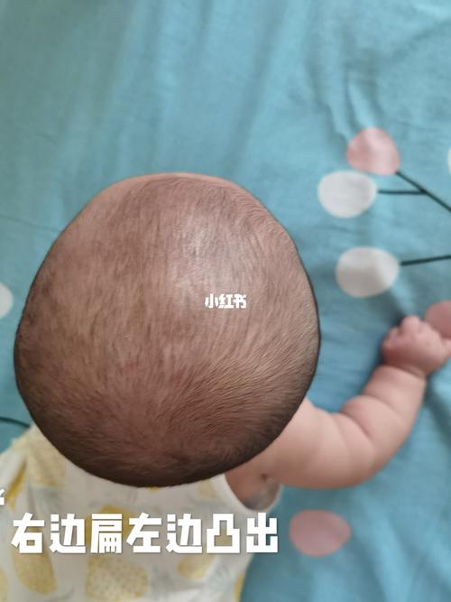 偏头 扁头矫正头型第一天_头型_月子_肠胀气_宝宝头型