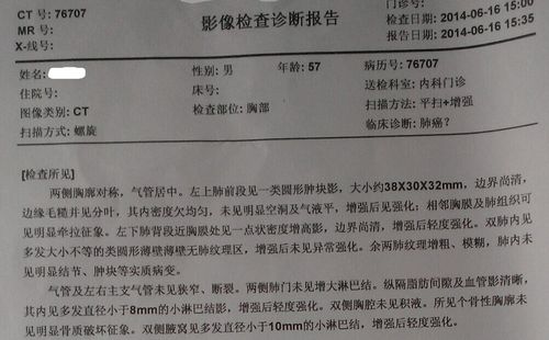 ct检查能不能排除肺癌