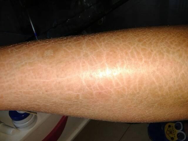 鱼鳞病去哪里看