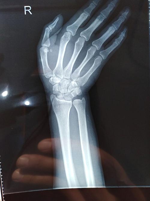 永城市中心骨科,手外科为你解忧愁