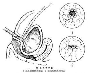 膀胱镜下膀胱颈悬吊术