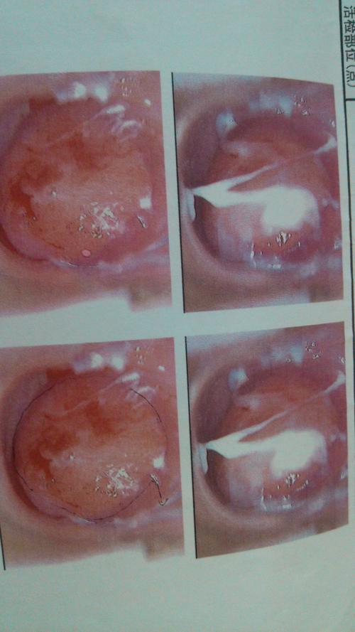 专业的医师帮忙看看这个阴道镜上有宫颈息肉还是有宫颈糜烂?