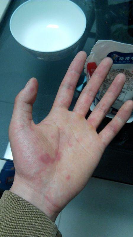 手上长红斑,两,三天就从一个点,扩大到片