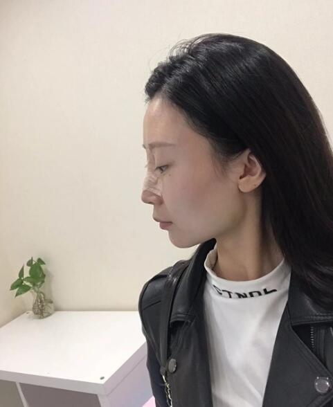 隆鼻1到7天恢复过程图片 隆鼻100多天了心得历程分享